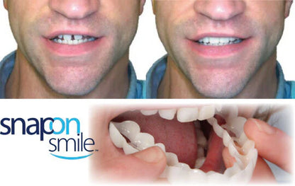 Carillas HappySmile dentales